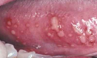 Herpes stomatitis in children pictures