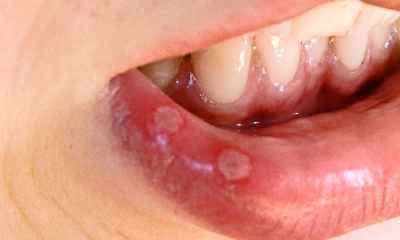 Herpetic stomatitis in children photos