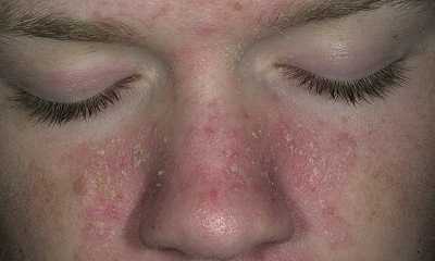 Seborrheic dermatitis face pictures