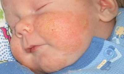 Seborrheic dermatitis in children pictures