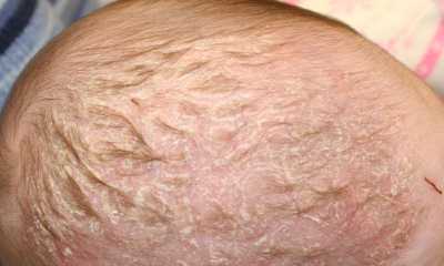 Seborrheic dermatitis in infants pictures