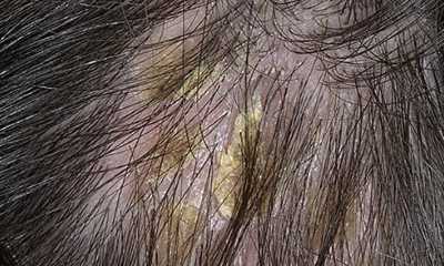 Seborrheic scalp dermatitis pictures