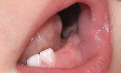 Stomatitis in infants pictures