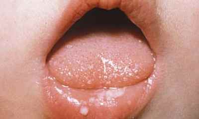 Stomatitis in newborns pictures