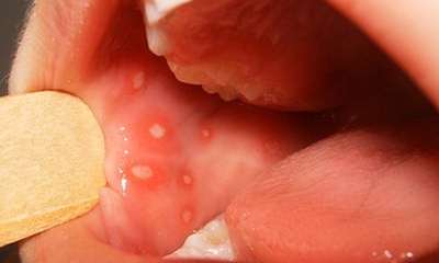 Viral stomatitis photos in children