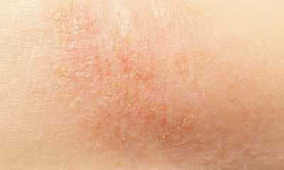 atopic dermatitis pictures