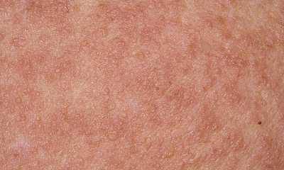 atopic dermatitis pictures in adults