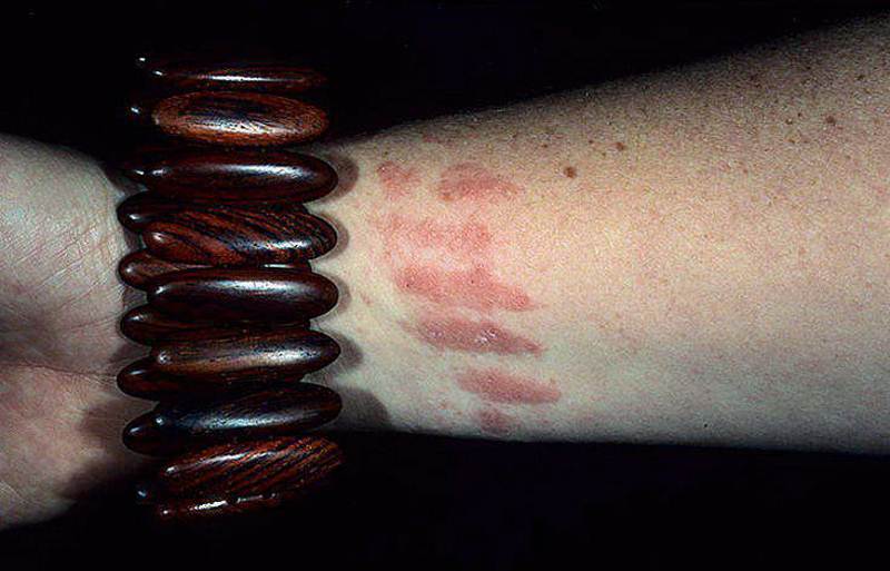 Nickel Dermatitis Pictures Symptoms And Pictures