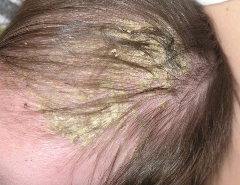 scalp dermatitis pictures | Symptoms and pictures