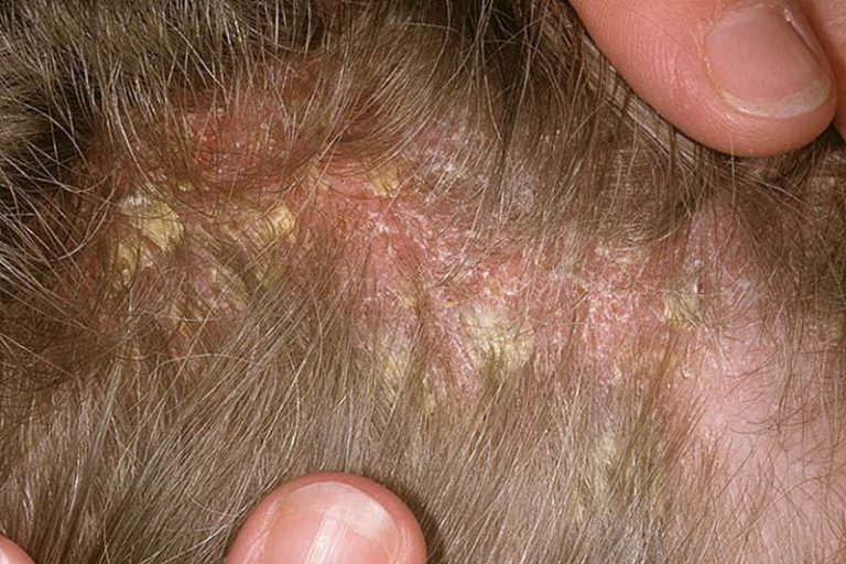 seborrheic dermatitis scalp icd 10 code