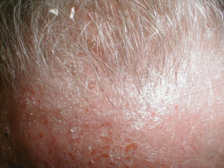 Severe Atopic Dermatitis Pictures Symptoms And Pictures 3601