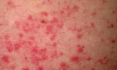 topical dermatitis pictures