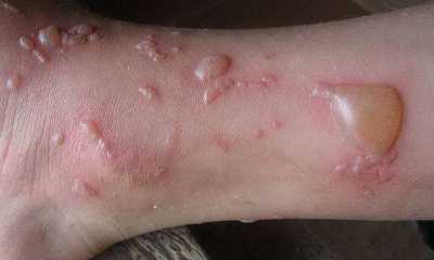 Bullous dermatitis pictures