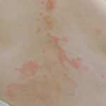 Contact dermatitis rash pictures