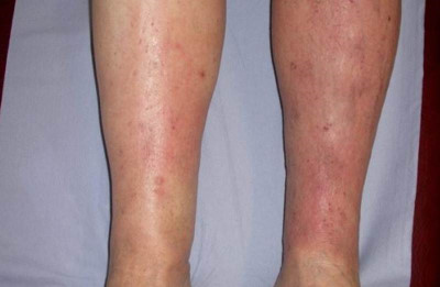 Dermatitis on legs pictures