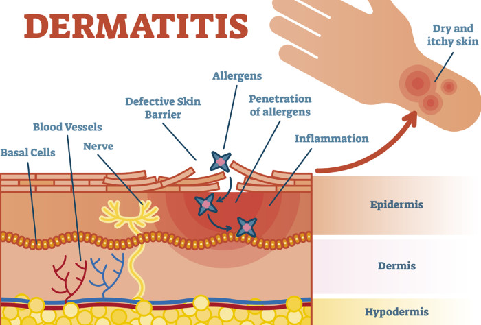 Dermatitis pictures