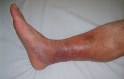 Foot dermatitis pictures