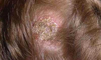 Fungal dermatitis images