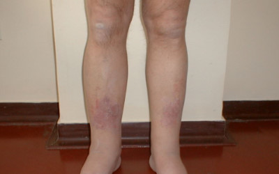 Images of dermatitis on legs