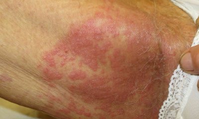 Intertriginous dermatitis pictures