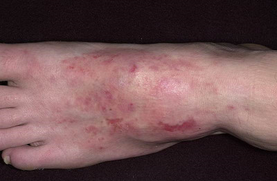 Nummular dermatitis photos