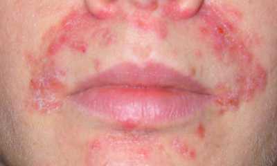 Perioral dermatitis photos