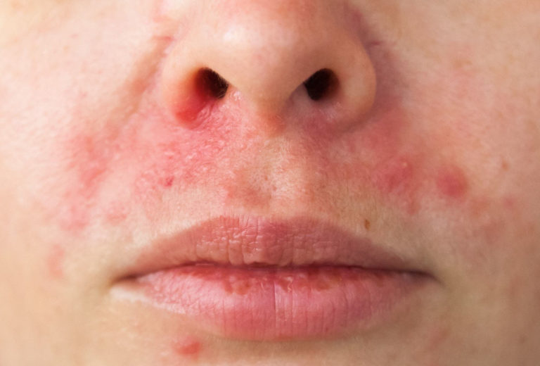 Perioral dermatitis pictures nose Symptoms and pictures