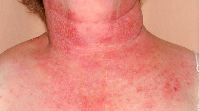 Photocontact dermatitis pictures | Symptoms and pictures