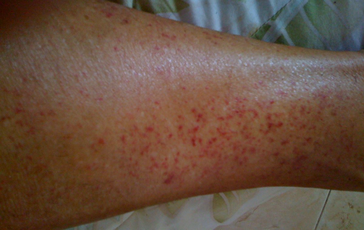 Photos of stasis dermatitis | Symptoms and pictures