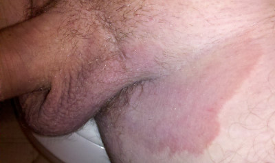 Scrotal dermatitis images