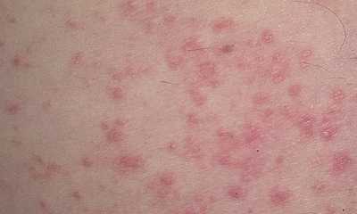 Textile dermatitis pictures