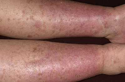 Venous dermatitis pictures