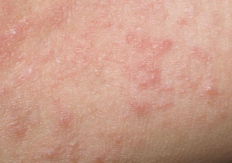 What does dermatitis look like Symptoms and pictures