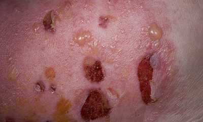 Bullous dermatitis pictures