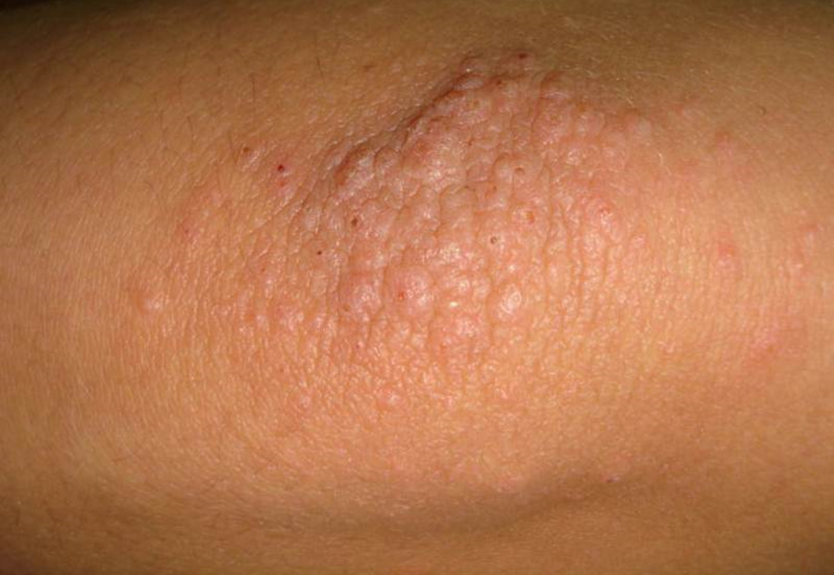 Causes Of Itchy Bumps On Elbows And What To Do About This Scary
