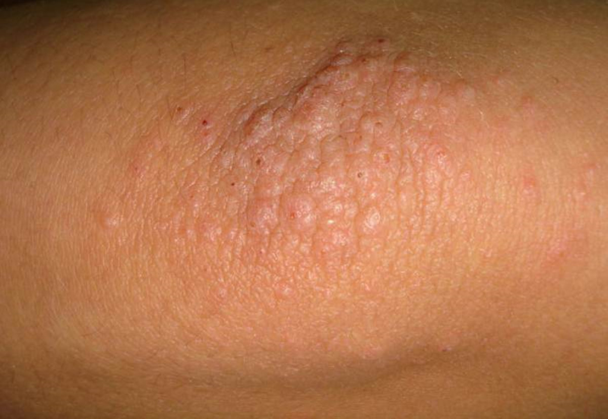 cluster-of-bumps-on-elbow