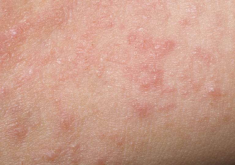 Dermatitis rash pictures | Symptoms and pictures