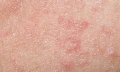 Dermatitis rash pictures