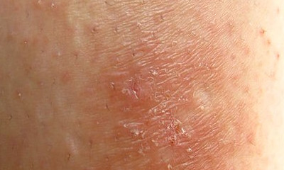 Neurodermatitis pictures