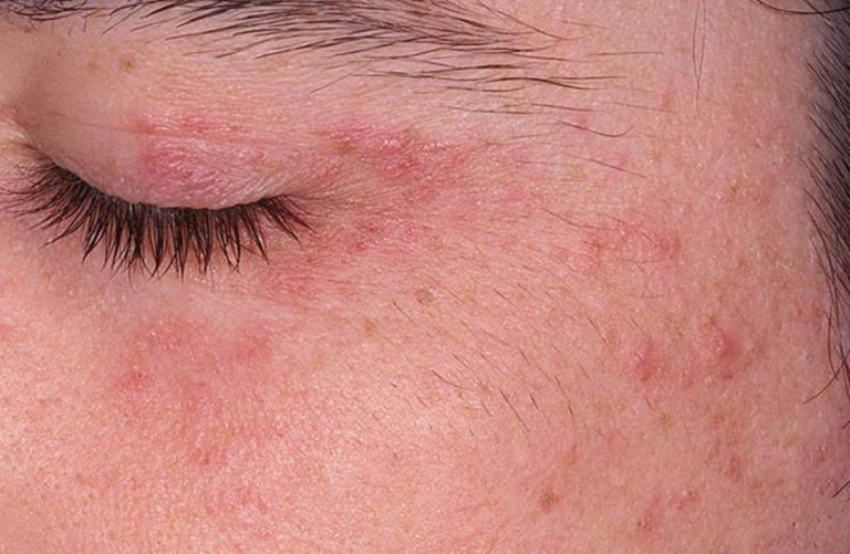 Periocular Dermatitis Pictures Symptoms And Pictures 