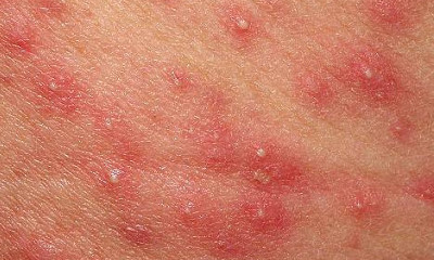 Pustular dermatitis pictures