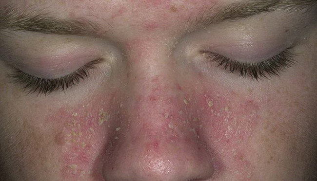 โรค seborrheic dermatitis gangrenosa infantum