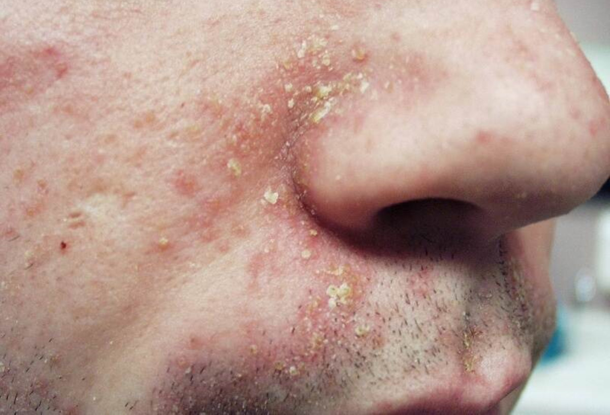 Zinc Seborrheic Dermatitis Face At Monte Stock Blog Zinc Seborrheic Dermatitis Face At Monte Stock Blog