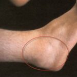 Ankle gout photos
