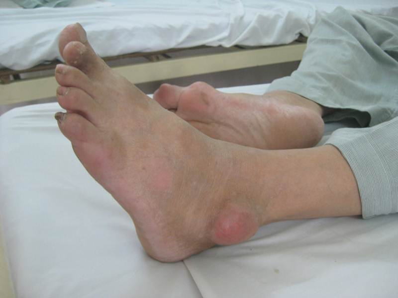 Ankle Gout Pictures Symptoms And Pictures 7972