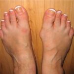 Feet gout pictures