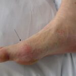 Gout of the foot pictures