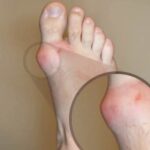 Gout on the feet images