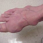 Gout on the feet photos