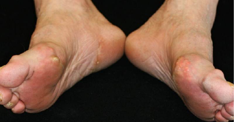 Gout on the feet pictures